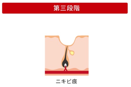 ニキビ発症の第三段階