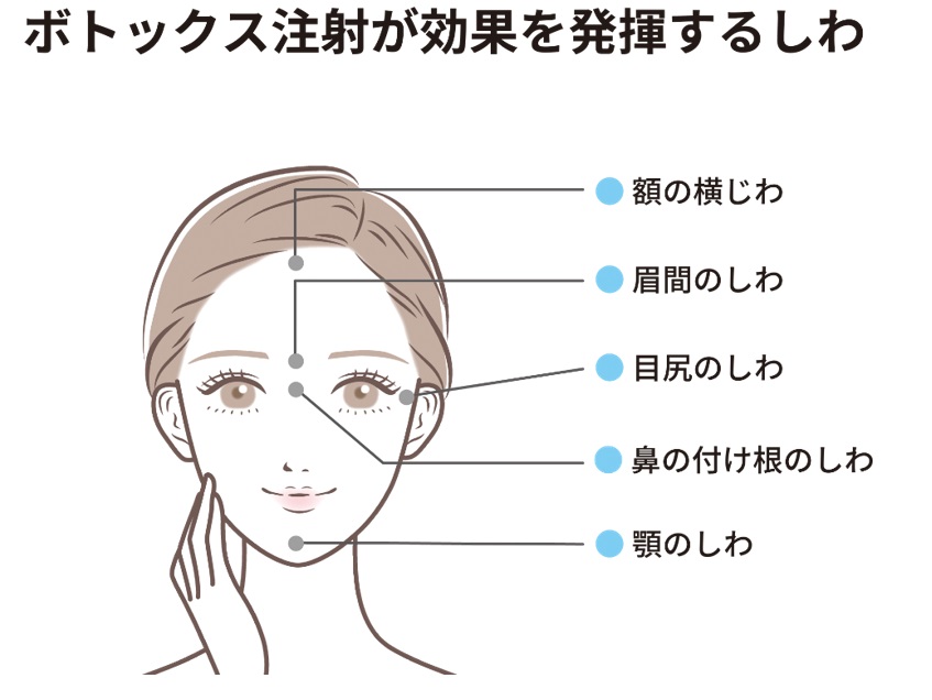 ボトックス注射が効果を発揮するシワ