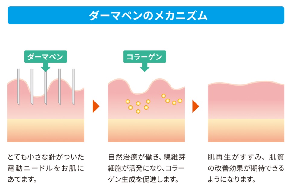 ダーマペンのメカニズムの図