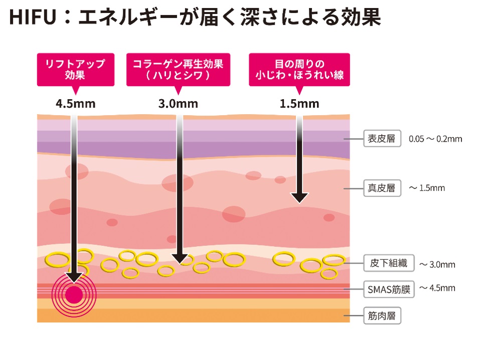  HIFUの効果を表した図