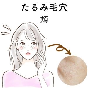 頬のたるみ毛穴