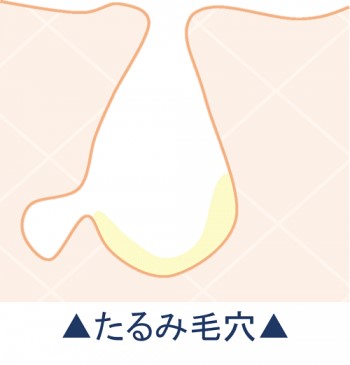 たるみ毛穴の図